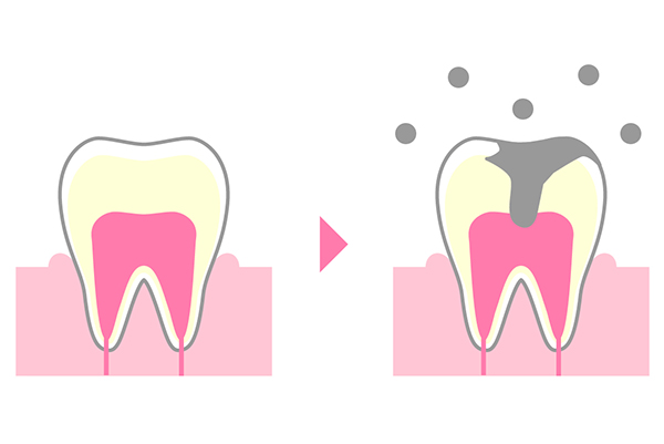 虫歯になってしまった歯
